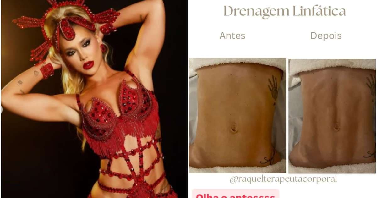 Virginia mostra antes e depois da drenagem linfática e seus benefícios